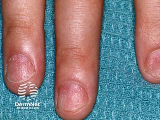 Rough nails with longitudinal pits due to twenty nail dystrophy