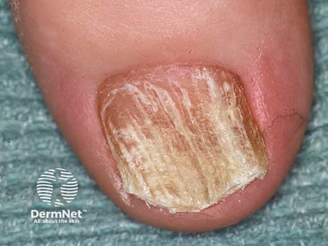 Severe ridging and dystrophy of the nail plate in twenty nail dystrophy