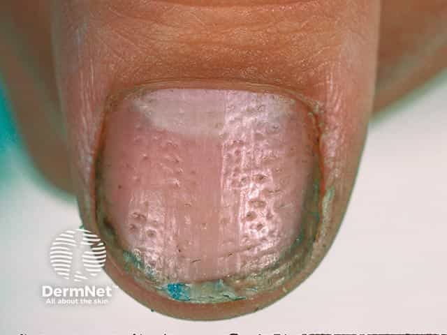 Multiple regular nail plate pits due to twenty nail dystrophy
