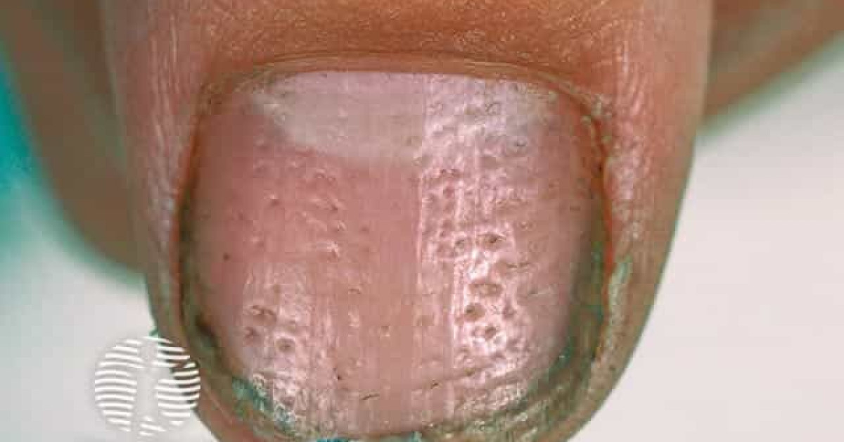 DermNet® - Twenty nail dystrophy image