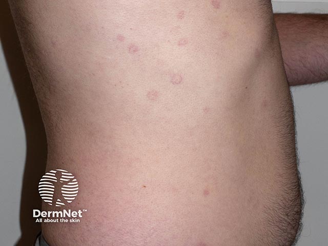 Annular lesions due to telangiectatic vessels in acquired annular telangiectasia