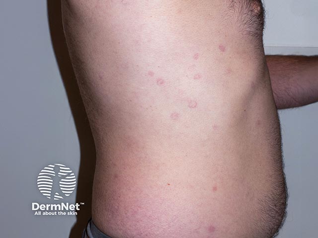 Annular lesions due to telangiectatic vessels in acquired annular telangiectasia