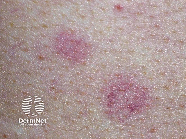 Close up showing the telangiectatic vessels arranged in a ring in acquired annular telangiectasia