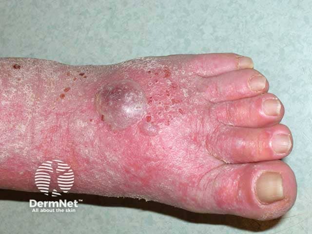 Severe lichen planus on the foot producing blisters