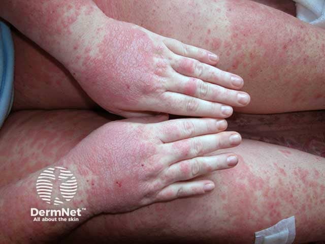 Severe lichen planus on the hands and legs
