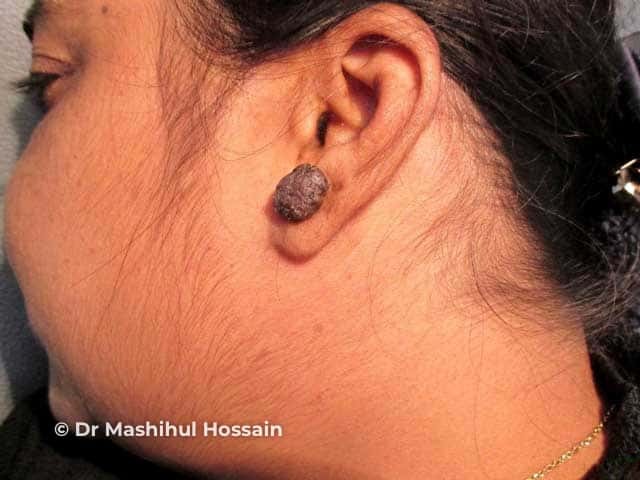 Viral wart: earlobe