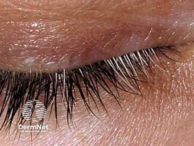 Vitiligo on the lid with poliosis of the lashes