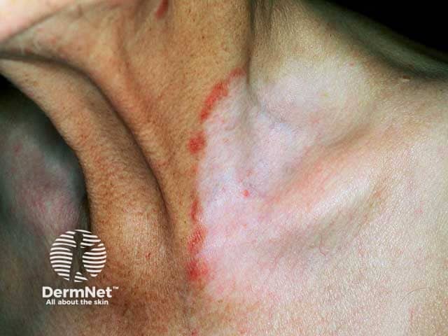 Vitiligo over the neck with an inflammatory border