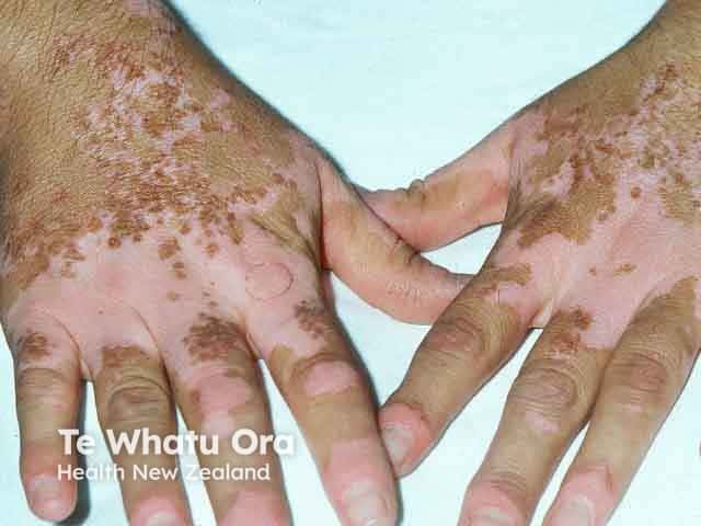 Symmetrical vitiligo on the hands and finger tips