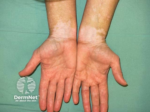 Symmetrical wrist vitiligo - a common location