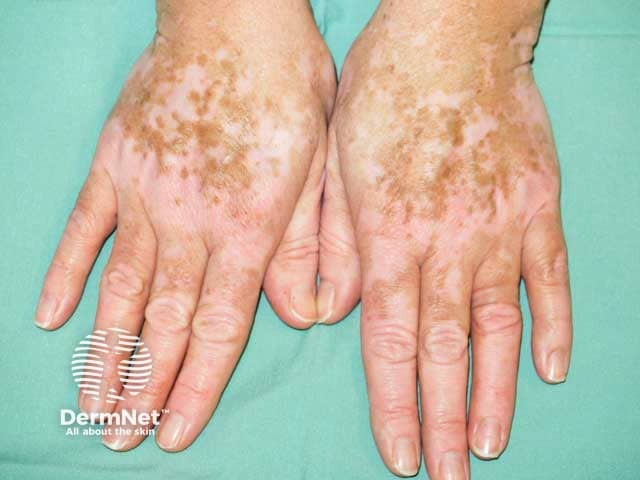 Dorsal hand vitiligo