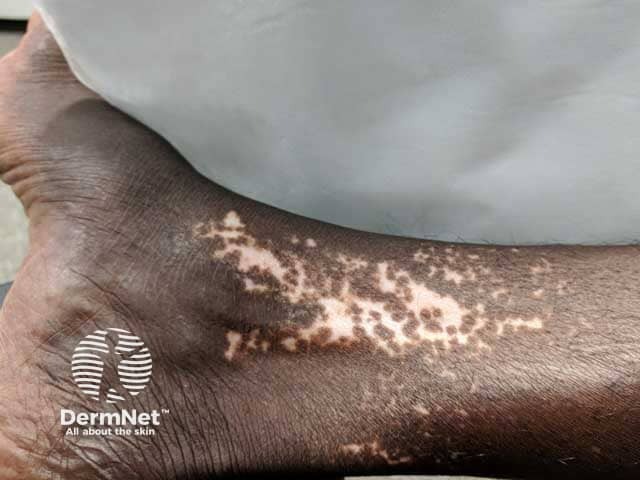 Vitiligo on the ankle in an African man