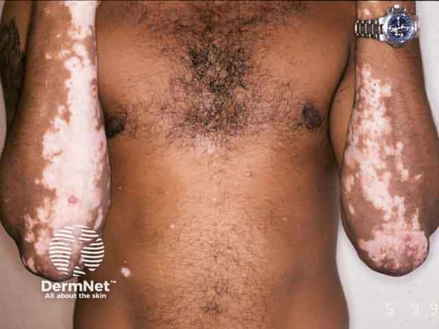 Symmetrical vitiligo on the arms