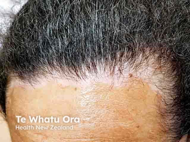 Vitiligo around the hairline of a Samoan woman
