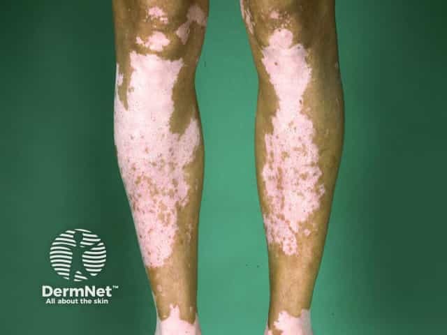 Vitiligo on the legs - symmetry is a usual feature