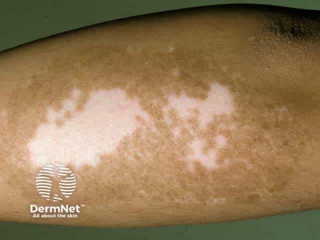 Vitiligo on a limb - note the marginal hyperpigmentation often seen when repigmentation has occured