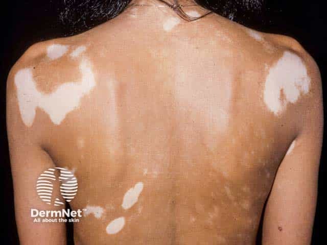Typical milk white well demarcated symmetrical depigmenation in vitiligo