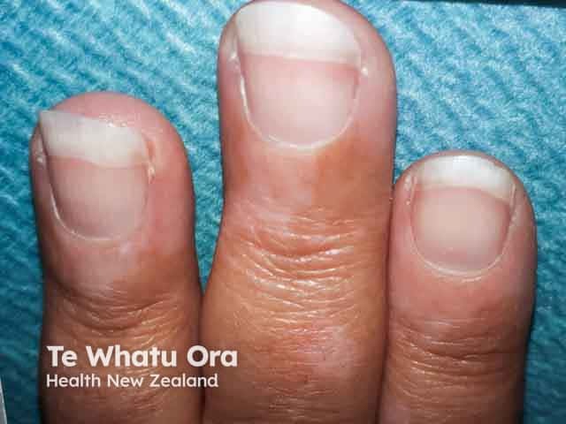 Vitiligo on the fingers