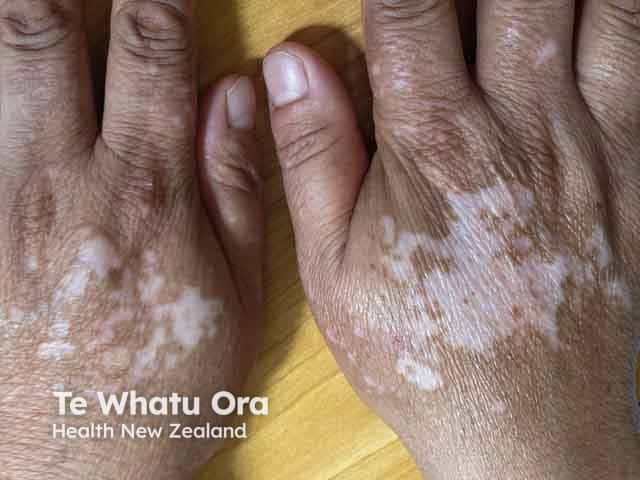 Vitiligo on the dorsal hands