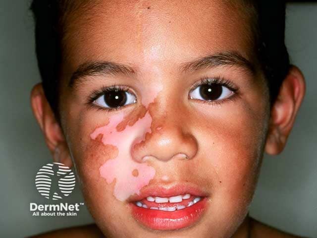 Segmental facial vitiligo