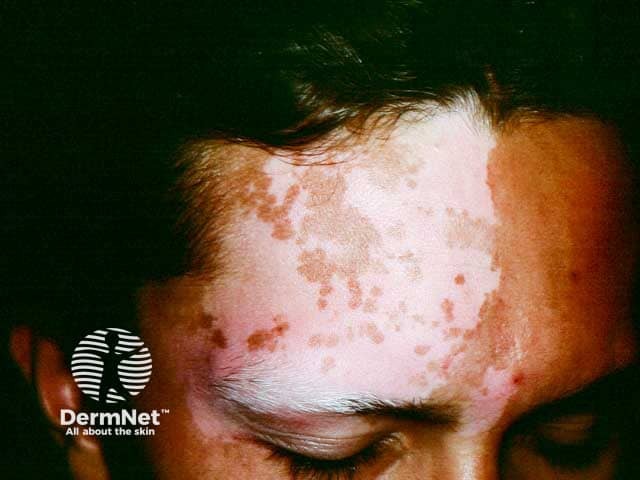 Segmental vitiligo on the temple with lid poliosis