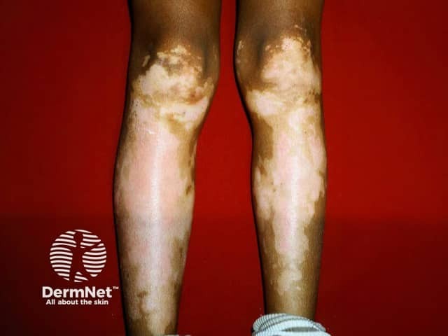 Symmetrical vitiligo on the shins in skin of colour