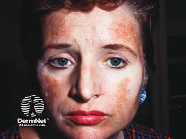 Extensive symmetrical facial vitiligo