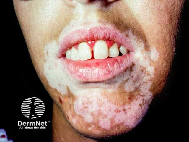 Perioral vitiligo