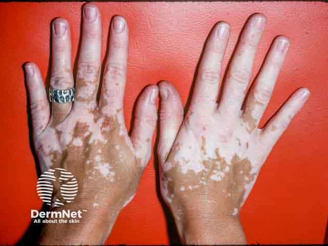 Vitiligo of the fingers and dorsal hands - note the striking symmetry