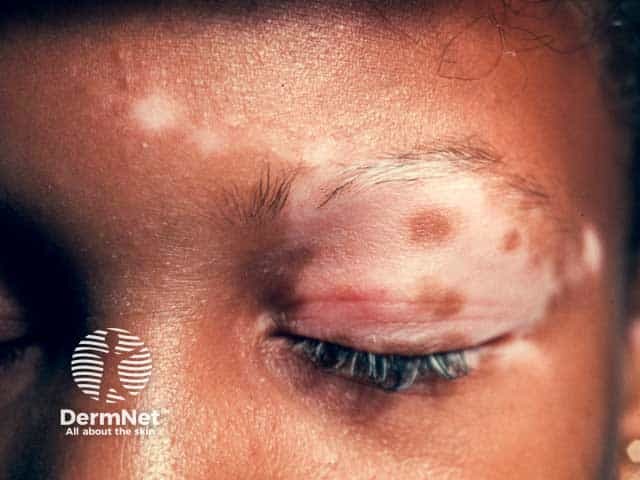 Segmental vitiligo on one lid and the ipsilateral forehead