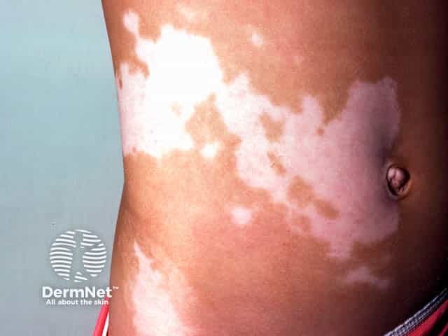 Segmental vitiligo on the trunk