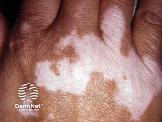 Vitiligo over the knuckles - keobnerisation due to trauma often localises vitiligo