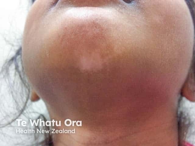 Vitiligo under the chin in an Indian girl