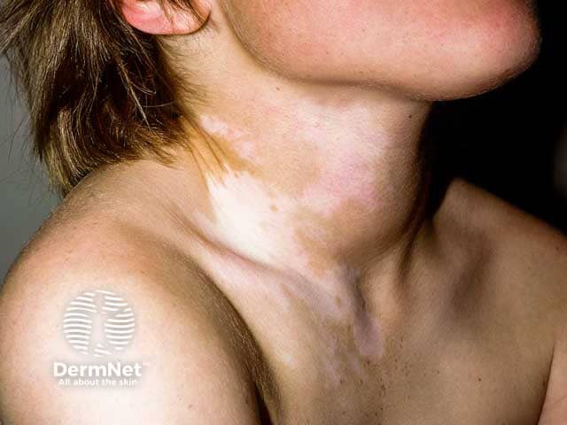 Vitiligo on the neck with some marginal hyperpigmentation