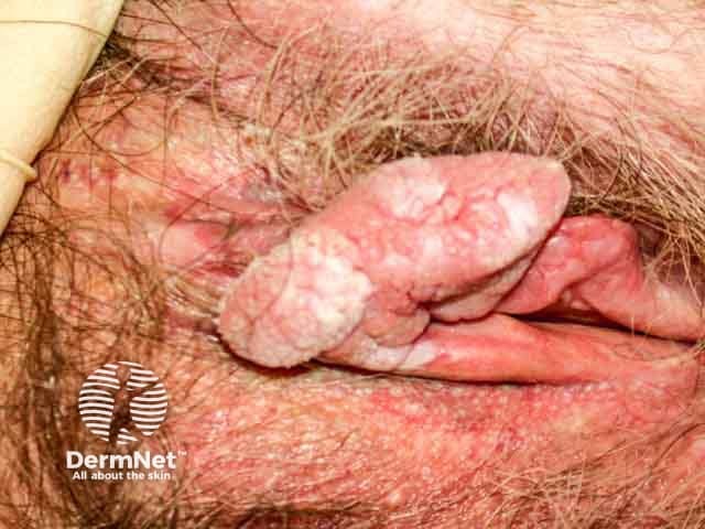 Warty vulval squamous cell carcinoma
