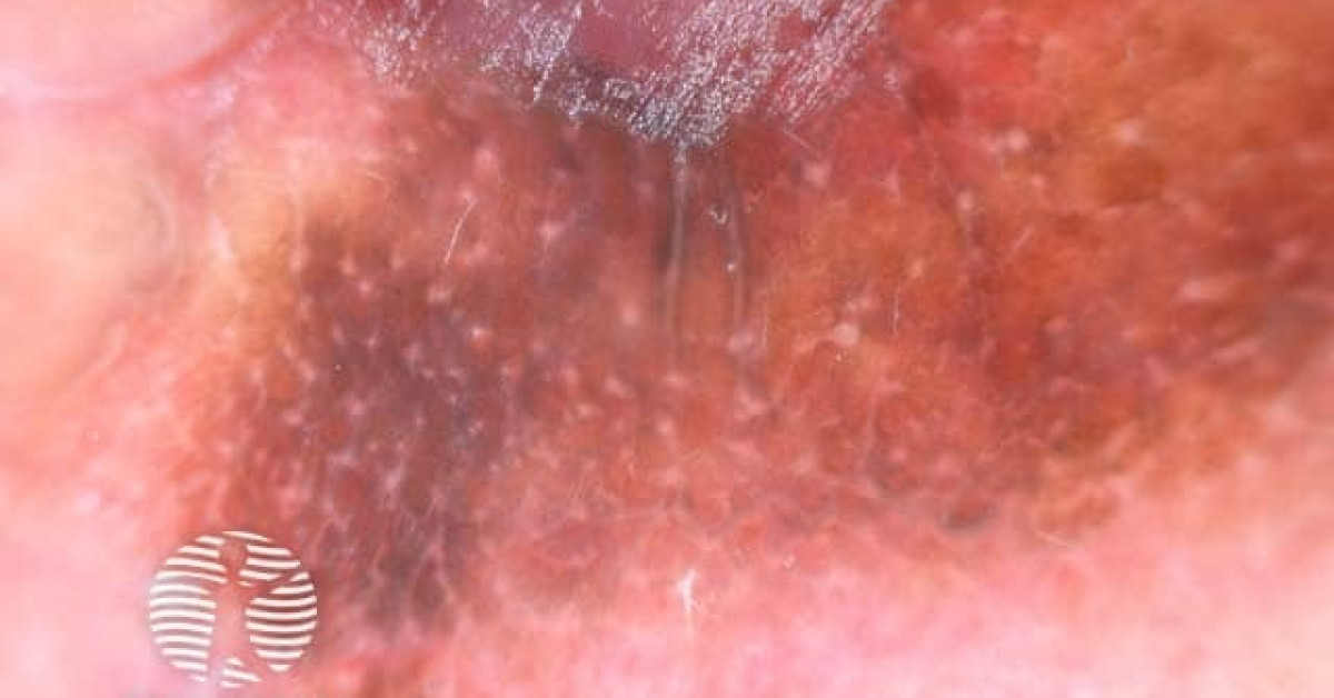 Vulval Cancer Image vulval-cancer-image