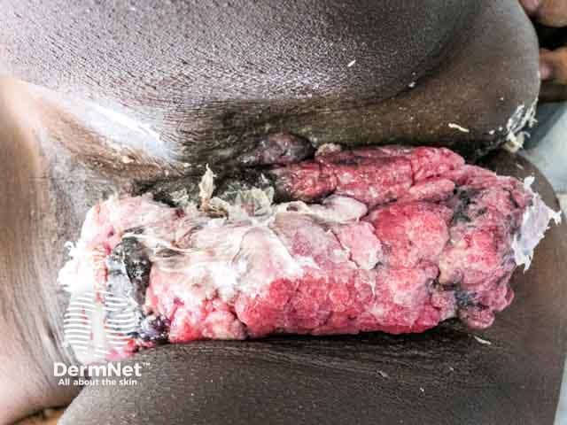 Advanced ulcerated vulval squamous cell carcinoma