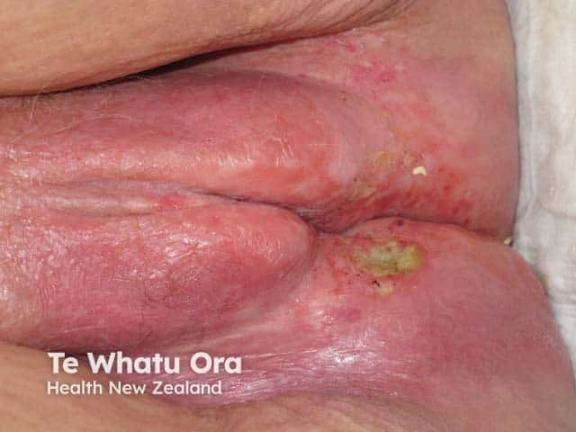 Squamous cell carcinoma arising on lichen sclerosus