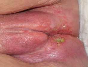 Vulval cancer