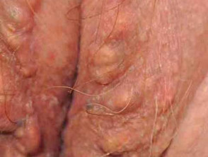 Lump on outer labia
