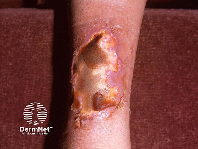 Necrosis induced by warfarin in an individual with protein C deficiency. The breasts and thighs are more common sites