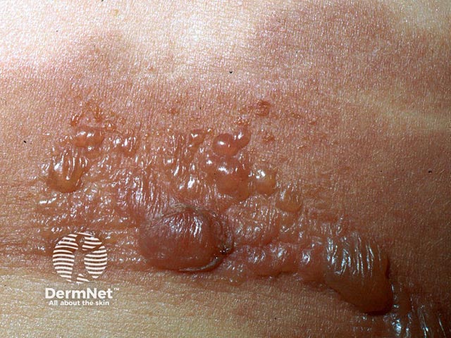 Bullous lesions of eosinophilic cellulitis on the abdomen