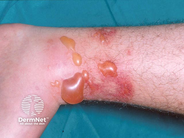 Bullous lesions within a plaque of eosinophilic cellulitis on the leg