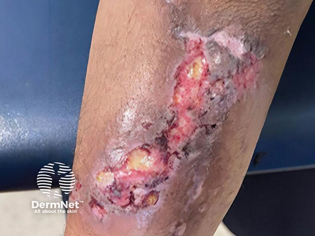 Ulceration on the forearm due to injection of the recreational drug xylazine. From Warp et al, Journal of Harm Reduction