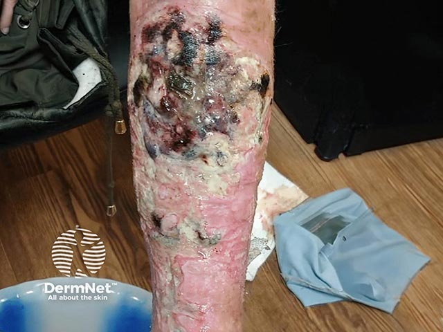 Necrotic leg ulcer due to injection of xylazine. From Malayala et al, Cureus