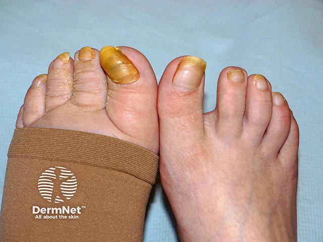 Yellow nails on the left foot that also has lymphoedema