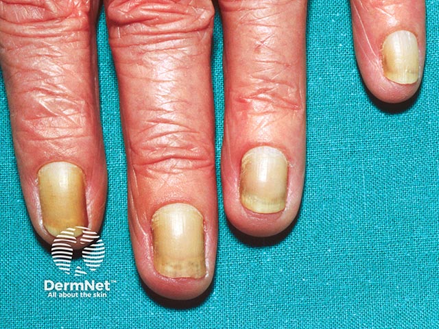 Slow growing and laterally curved yellow nails - there was associated bronchiectasis