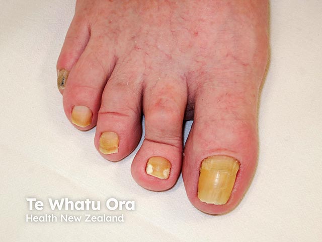 Yellow nail syndrome affecting the toe nails - there is also some superfical white onychomycosis affecting the second nail plate