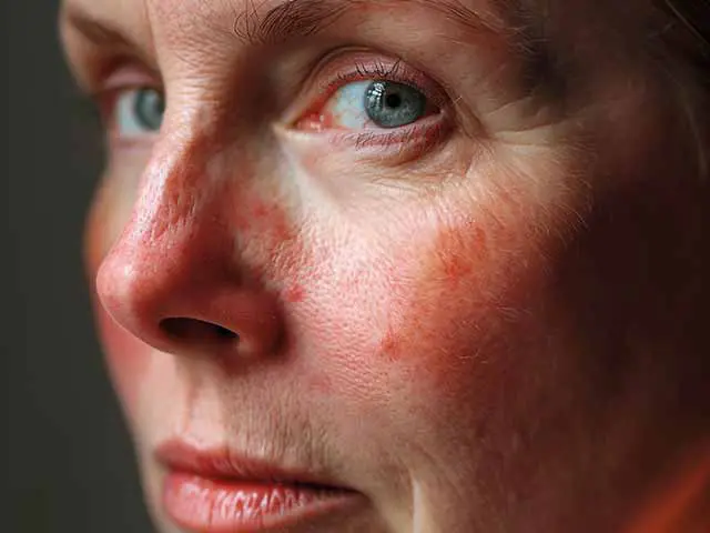 What’s triggering my rosacea?