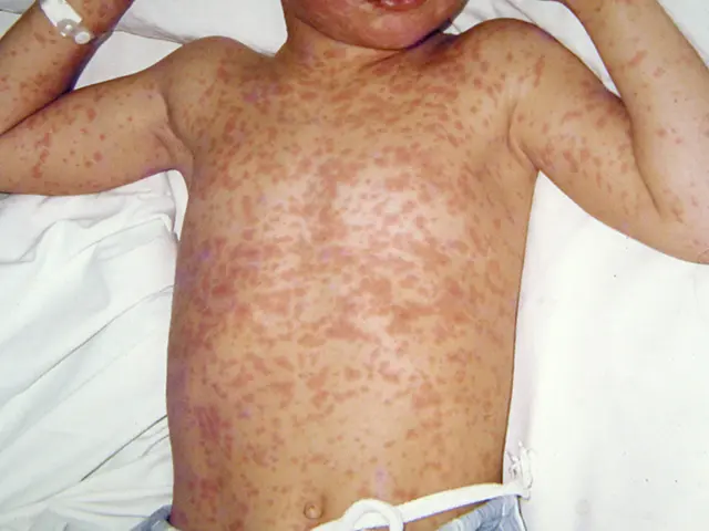 Measles images